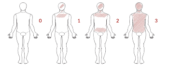Guidance on scoring Atopic Eczema.