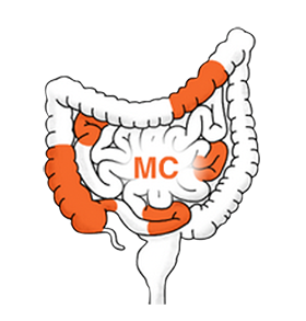 Morbus Crohn