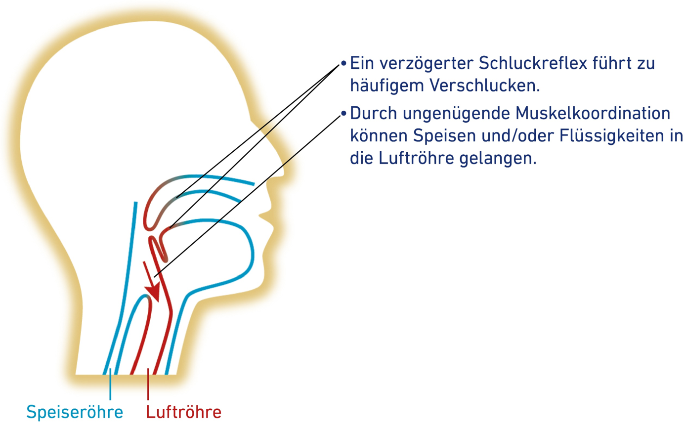 Schluckakt bei Aspiration