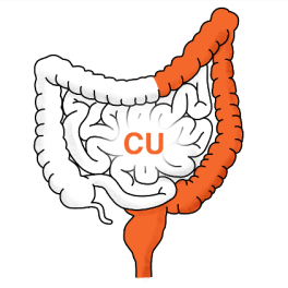 Morbus Crohn