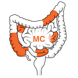 Morbus Crohn