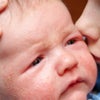 Säugling Joey zeigt Haut-Symptome bei Kuhmilchproteinallergie